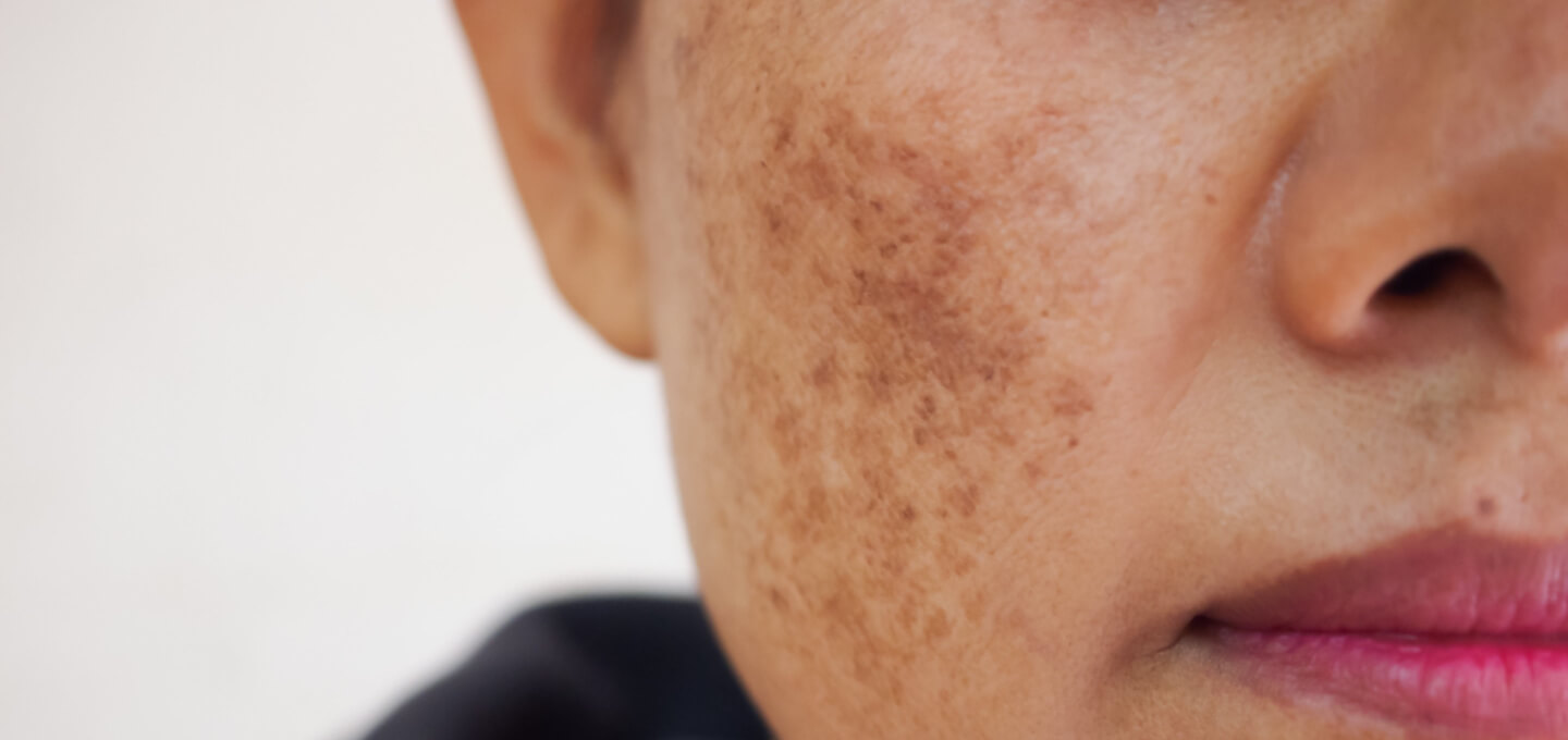 What Are the Side Effects of Melasma Treatments in Islamabad?