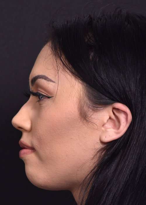 "Achieve Facial Harmony with Nose Surgery in Riyadh"