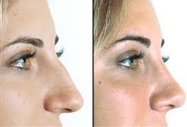 "Breathe Better, Look Better – Functional Nose Reshaping in Riyadh