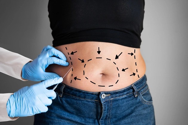 Get the Body You Deserve with Advanced Liposuction