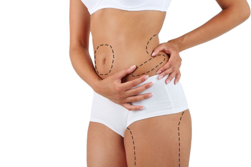 Reshape and Refine: Liposuction for Lasting Results