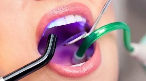 Cavity Treatment NYC to Protect Your Smile