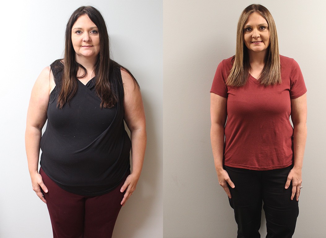 Get Ready for Summer: Liposuction to Boost Your Confidence