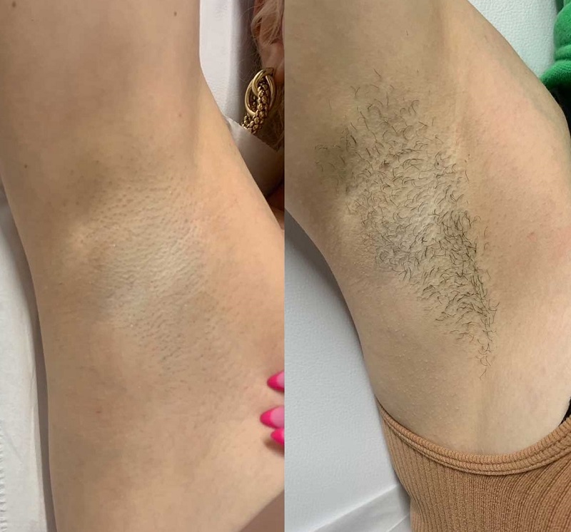 Get Beach-Ready Skin All Year with Laser Hair Removal