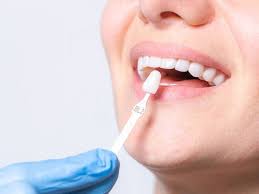 Are Composite Veneers Worth the Investment?