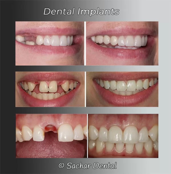 The Gold Standard in Tooth Replacement: Dental Implants