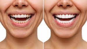 Composite Veneers Sydney: The Affordable Smile Makeover