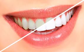 Teen Teeth Whitening: What Parents Should Know