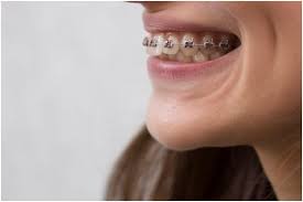 How Long Do I Need to Wear a Retainer?