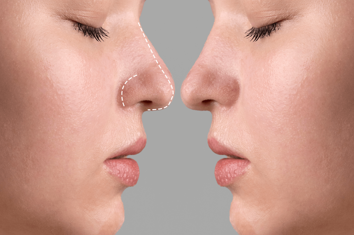 Is It Normal to Feel Numb After Rhinoplasty Surgery?