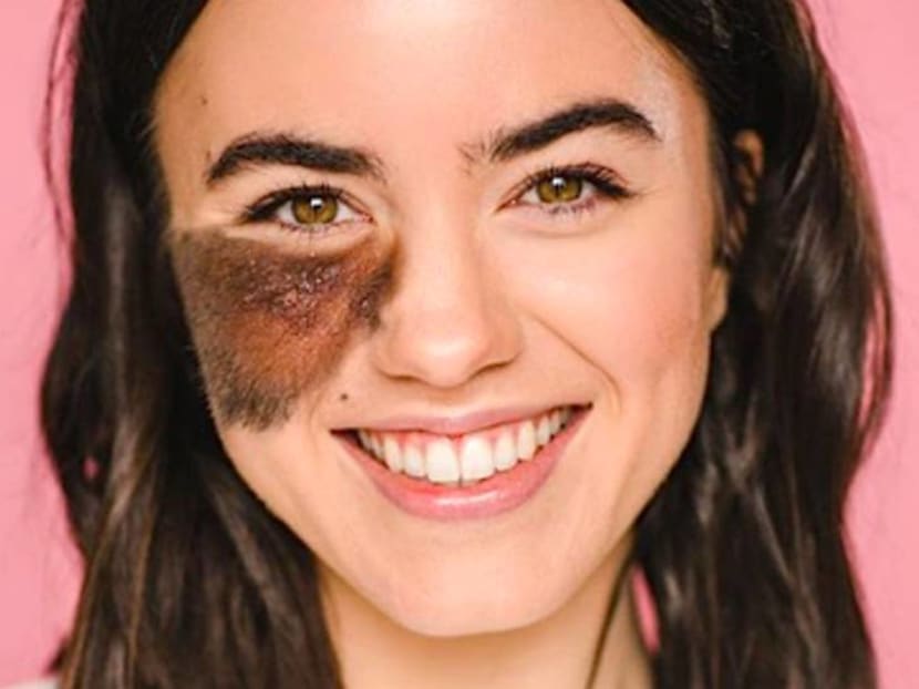 What is the Best Age For Birthmarks Removal Treatment?