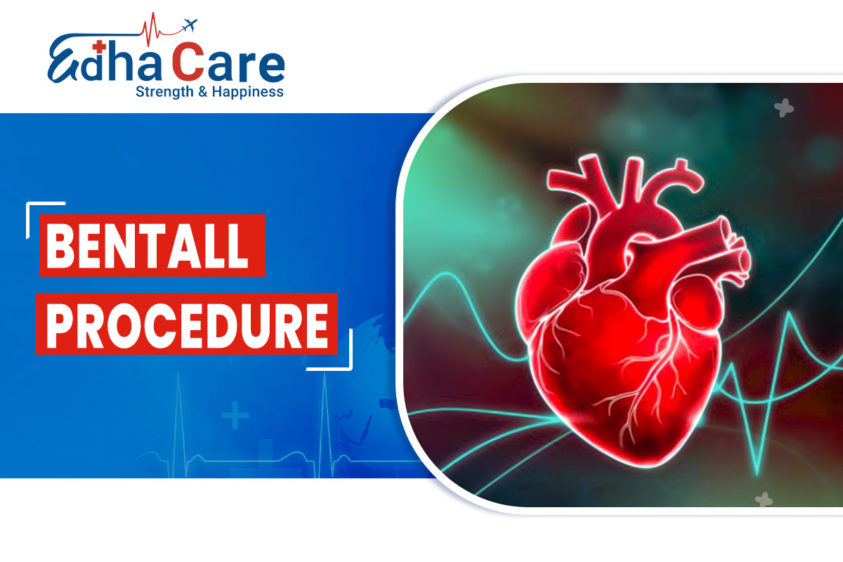 Bentall Procedure: Indications, Types, and Recovery with Edhacare