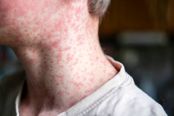 Step-by-Step Guide to Managing Skin Rashes and Hives Effectively