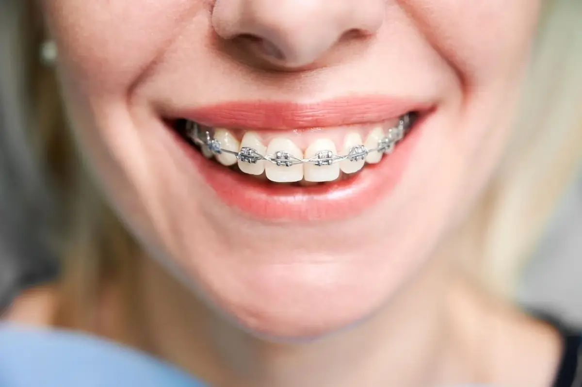 Personalizing Your Teeth Braces in Dubai