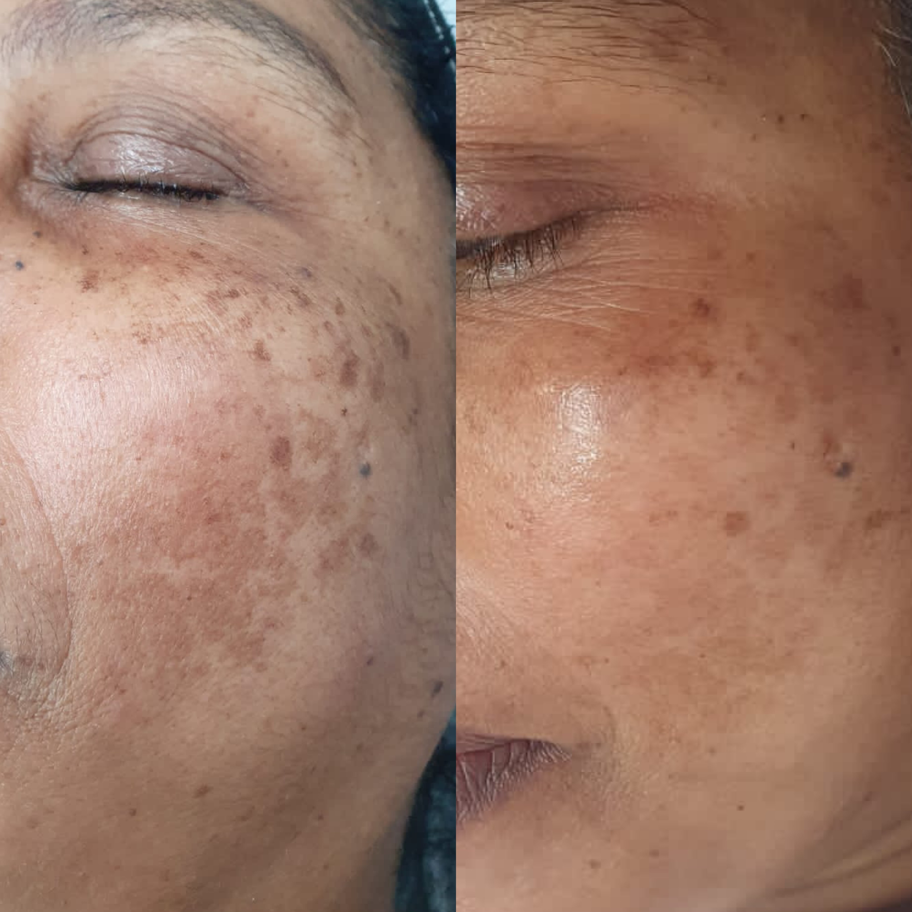 How to Get Rid of Face Pigmentation: Expert-Approved Solutions That Work