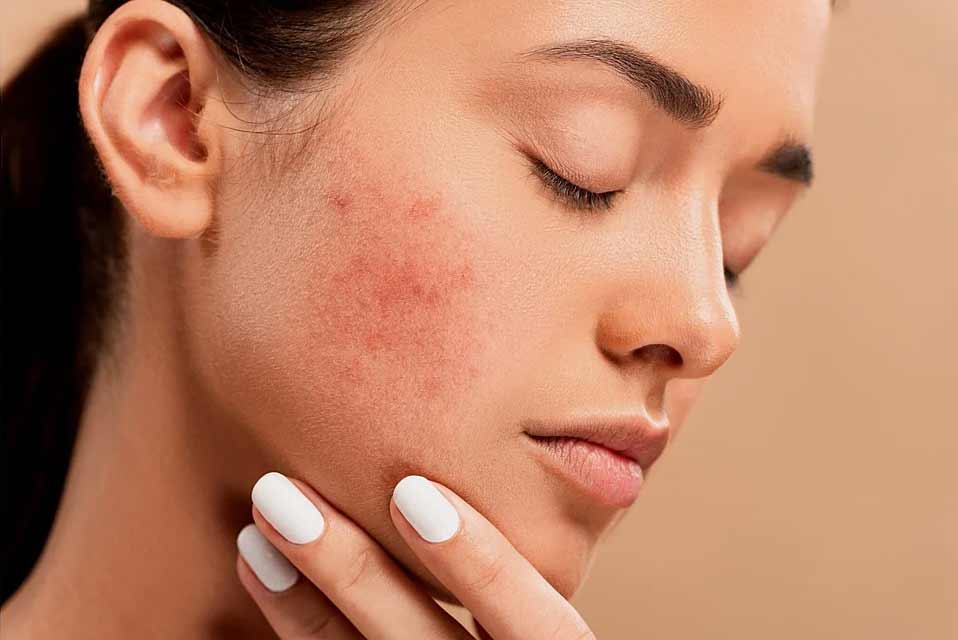 How Laser Treatments Help With Acne Scars and Pigmentation