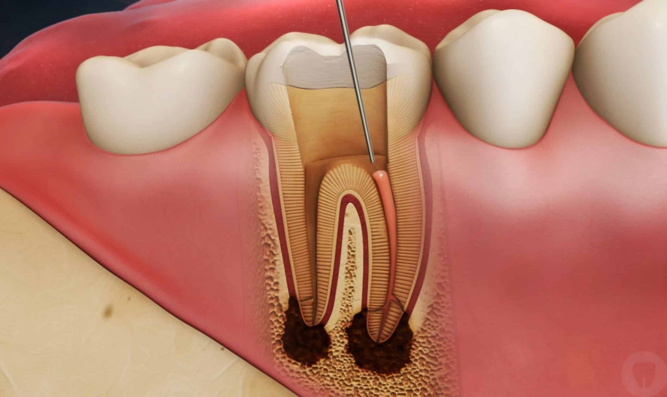 What Are Signs You Need a Root Canal?