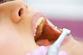 How to Tell If Your Dentist Is Recommending a Root Canal Too Soon?