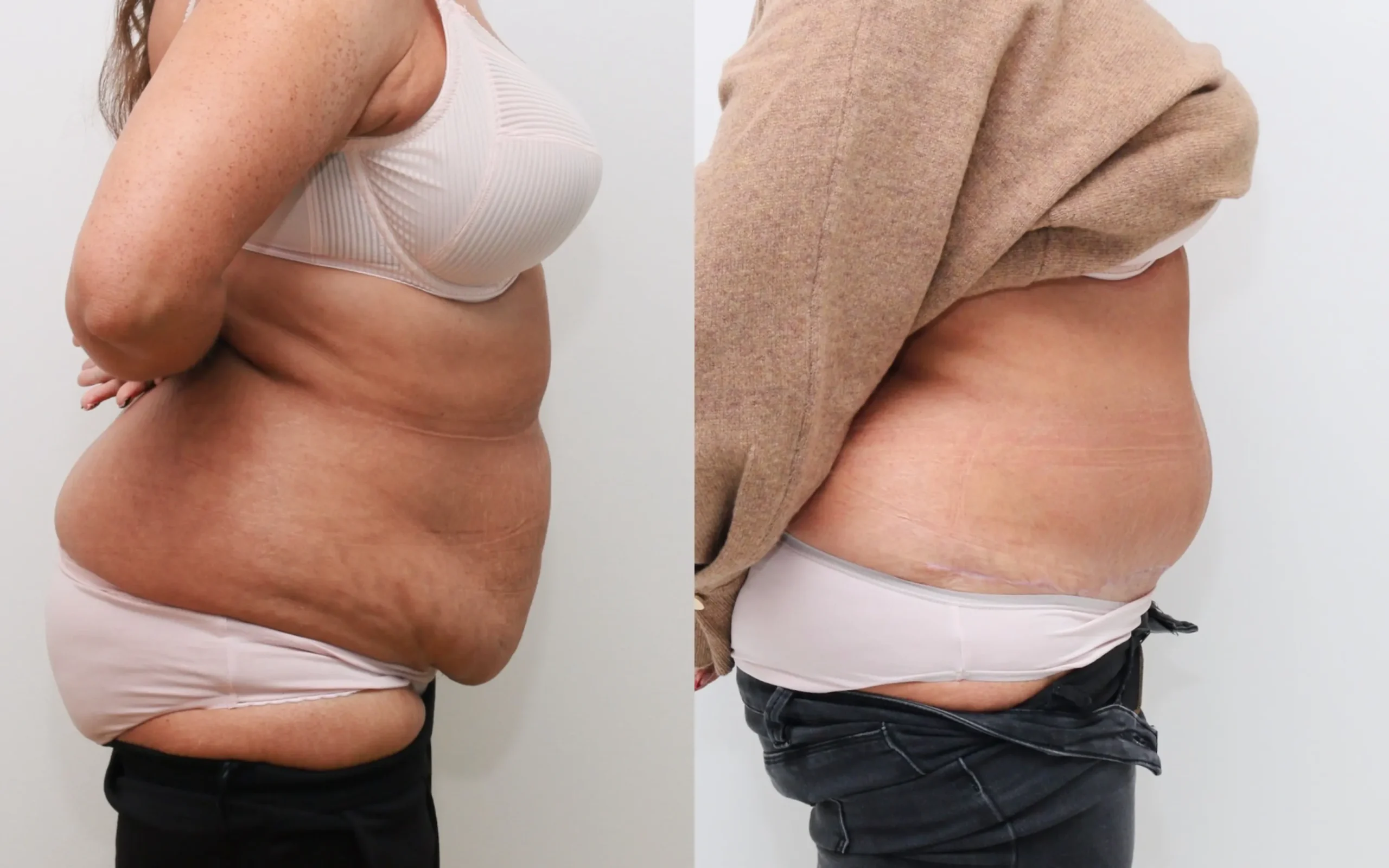 How a Tummy Tuck Can Boost Your Self-Esteem and Motivation