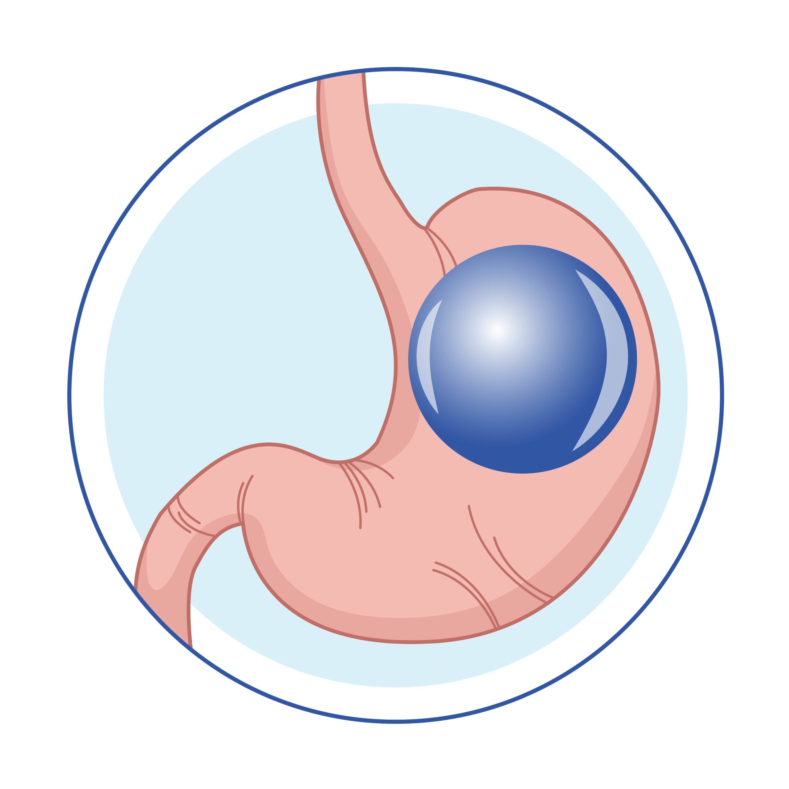 How Does Gastric Balloon Placement Work?