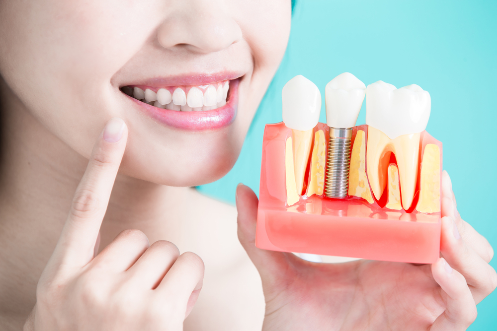 Permanent Single Tooth implant Services in Dubai