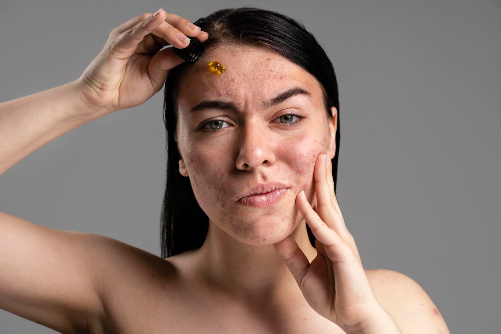 How to Get Rid of Acne from Oily Skin: Effective Solutions