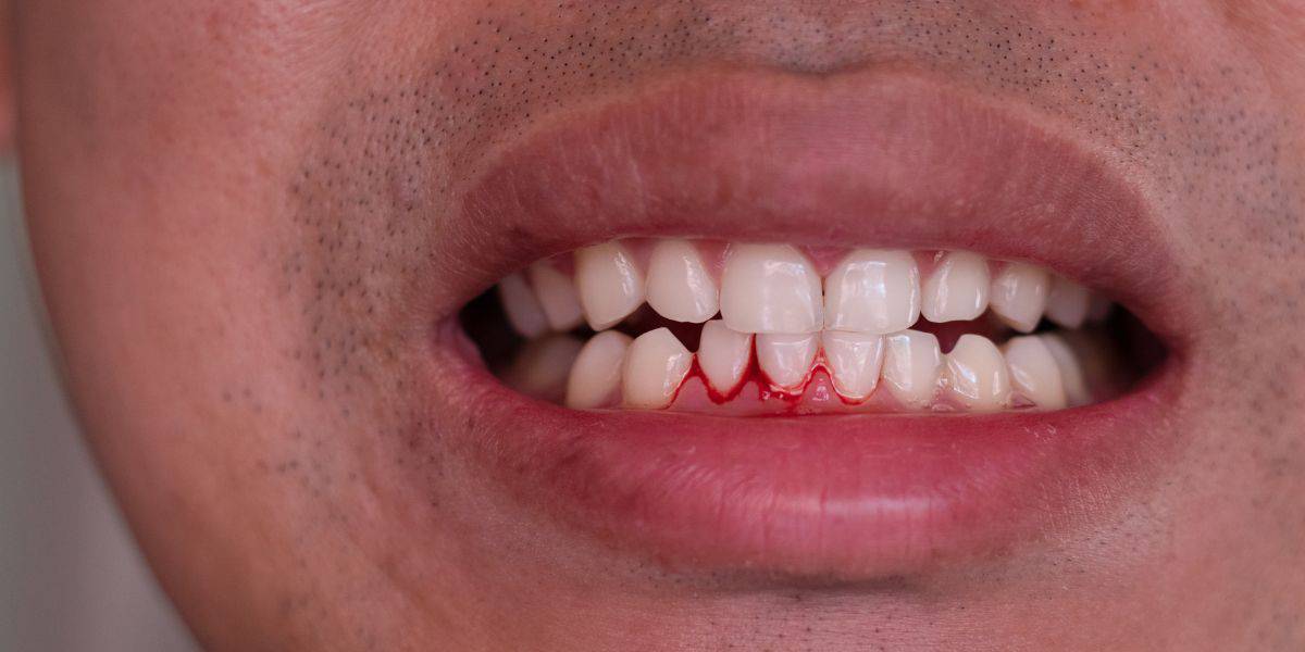 Understanding Gum Disease: Causes, Prevention, and Treatment