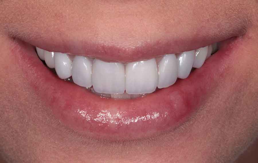 Dubai Teeth Whitening: What’s the Real Price?