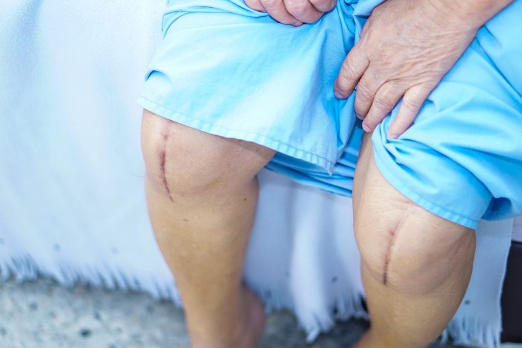 Is Knee Replacement Surgery Safe for Seniors?