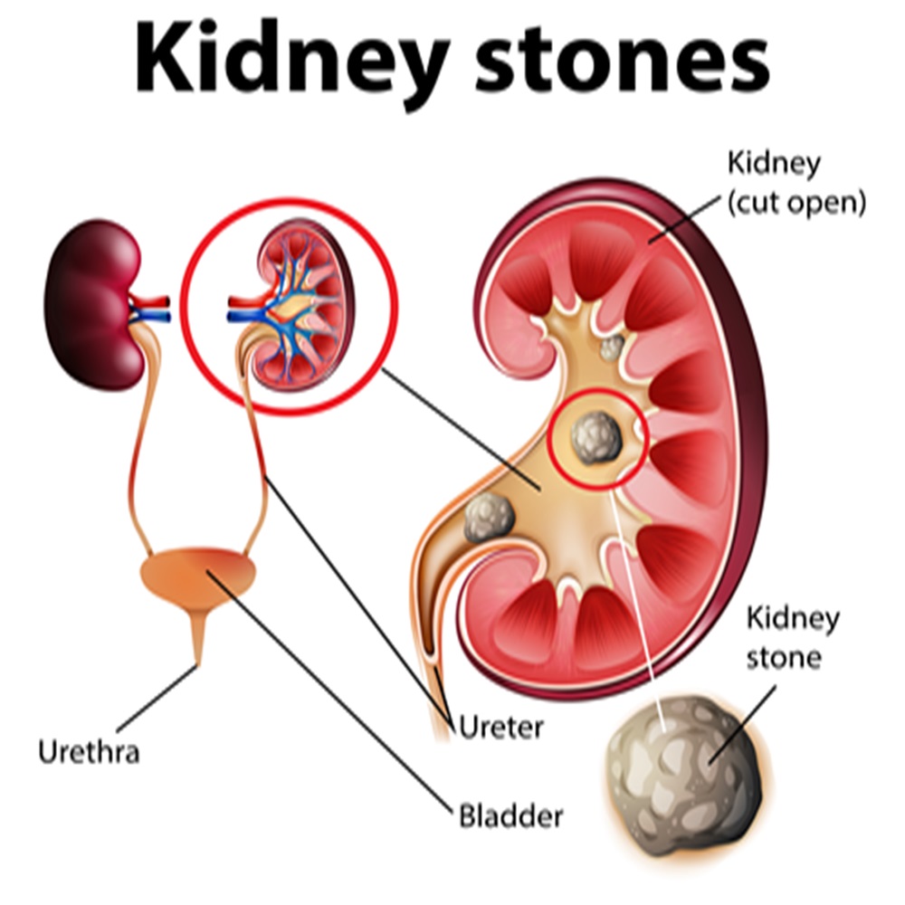 How Are Kidney Stones Formed?