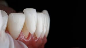 Is Getting Veneers Painful?
