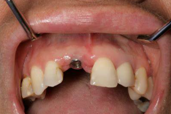 Trồng răng Implant bị sưng phải làm sao?