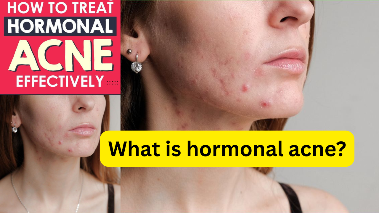 Hormonal Acne: Causes, Symptoms & Proven Solutions for Clear Skin