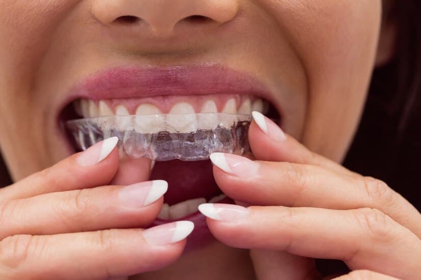 What to Expect During Your Invisalign in Westport Treatment