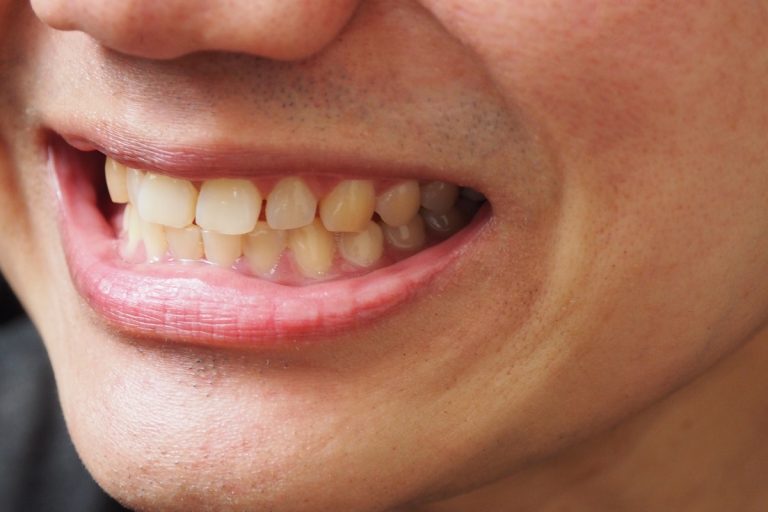 Do Tooth Color Fillings Stain Over Time? Tips from Fursungi Dentists