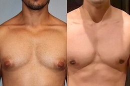 Choosing the Right Time for Your Gynecomastia Surgery
