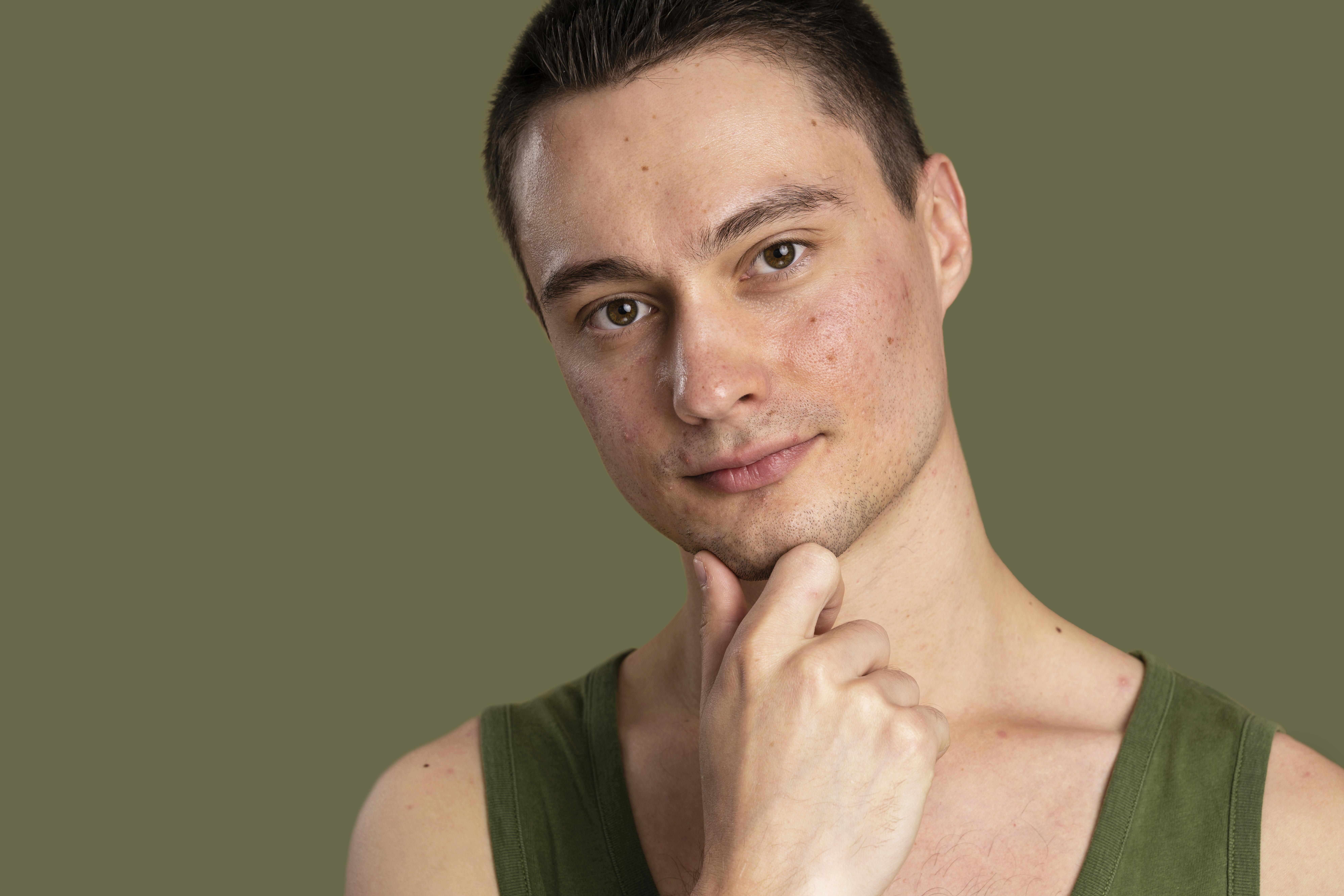 Is It Possible to Remove Acne from Oily Skin Permanently?