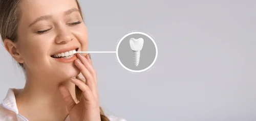 Why Dental Implants Are the Best Long-Term Solution for Missing Teeth