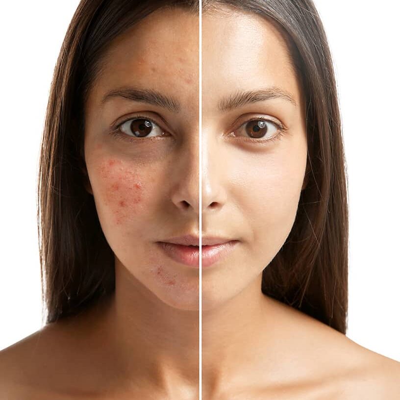 Can Dark Acne Scars Fade Without Professional Help?