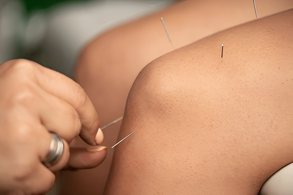 Acupuncture for Weight Loss: Does It Actually Work?