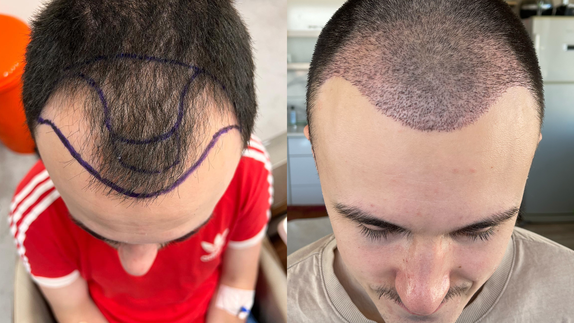 Hair Transplant Aftercare Tips for Faster Healing and Growth