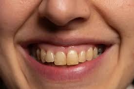 Can Dental Cleanings Remove All Types of Stains?