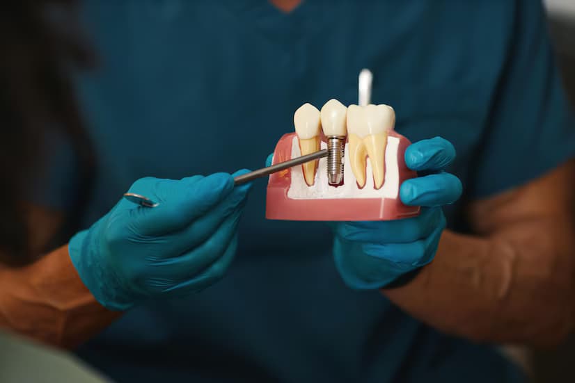 Everything You Need to Know About Dental Implants in Turkey