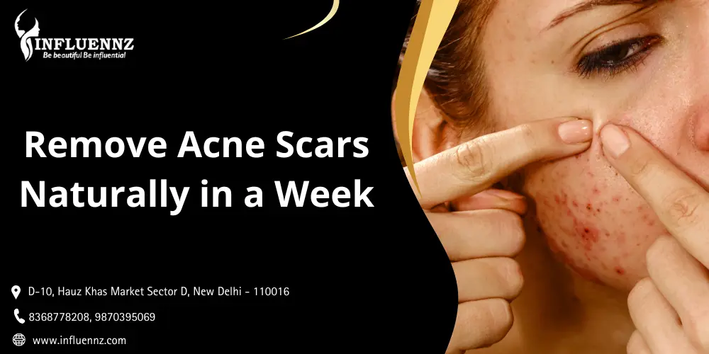 How to remove acne scars naturally in a week