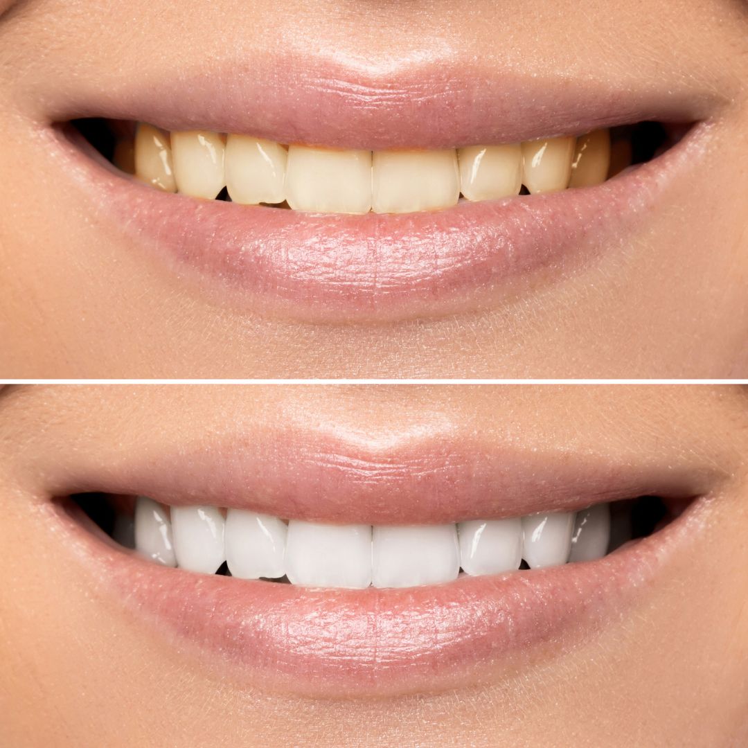 Teeth Whitening Tips to Get a Brighter Smile Fast