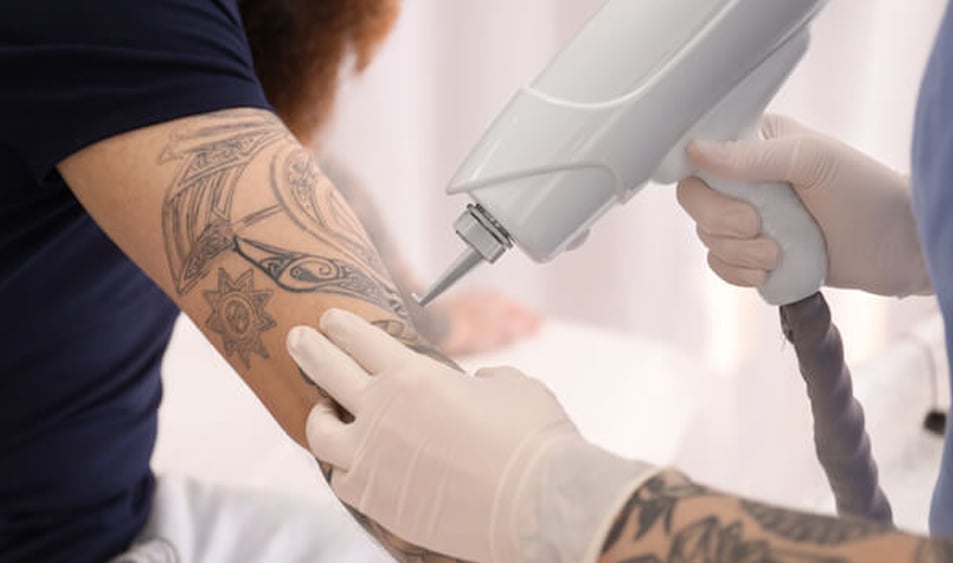 What Are the Limits of Laser Tattoo Removal?
