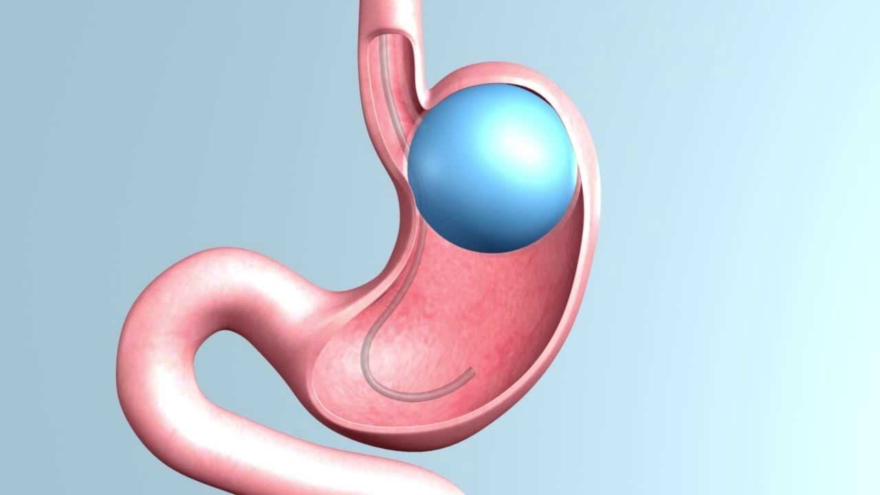 What To Expect After Getting A Gastric Balloon?