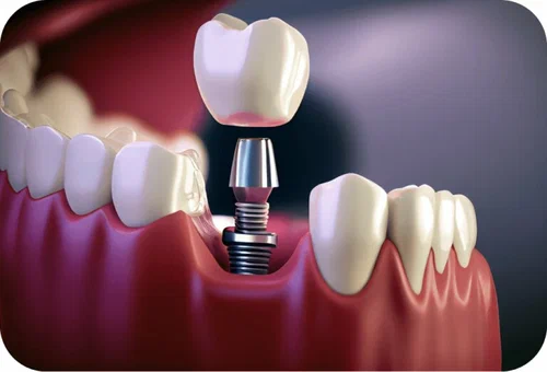 What Determines the Price of Dental Implant in Islamabad?
