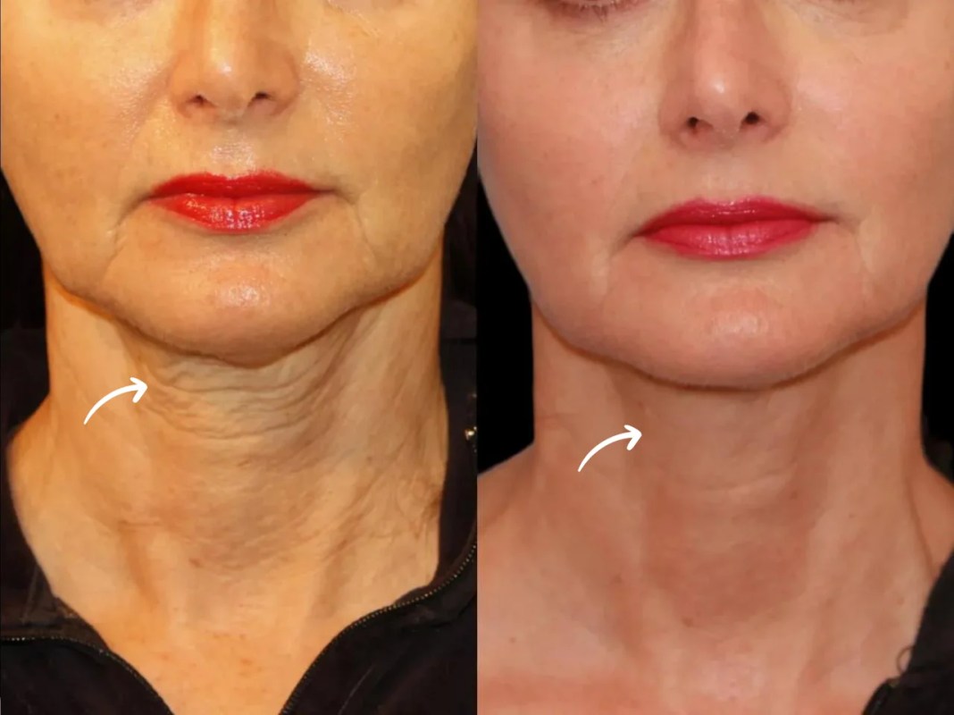 Stress, Aging, and Skin Health: How Sculptra Fillers Treatments in Dubai Can Help