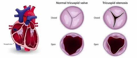 Understanding Stenosis: Causes, Symptoms, and Effective Treatments